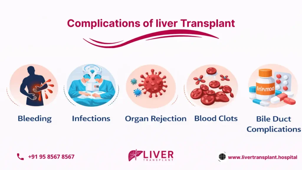 Complications of liver Transplant 