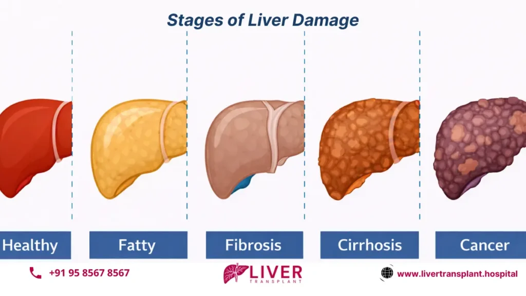 Stages of Liver Damage 