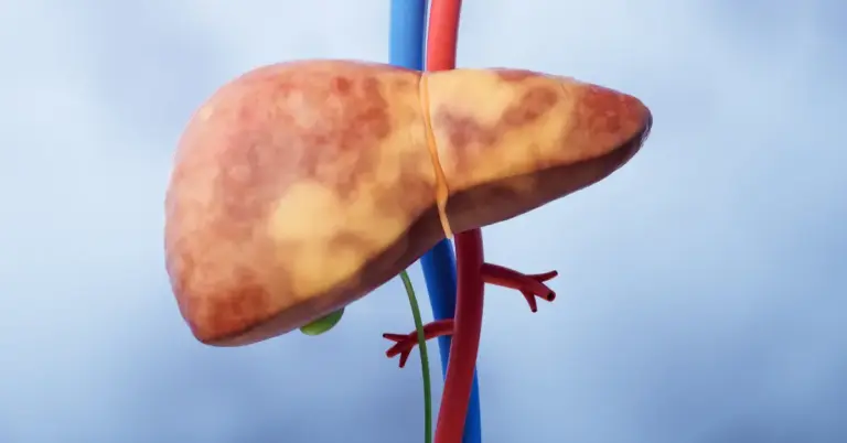 End-Stage Liver Disease
