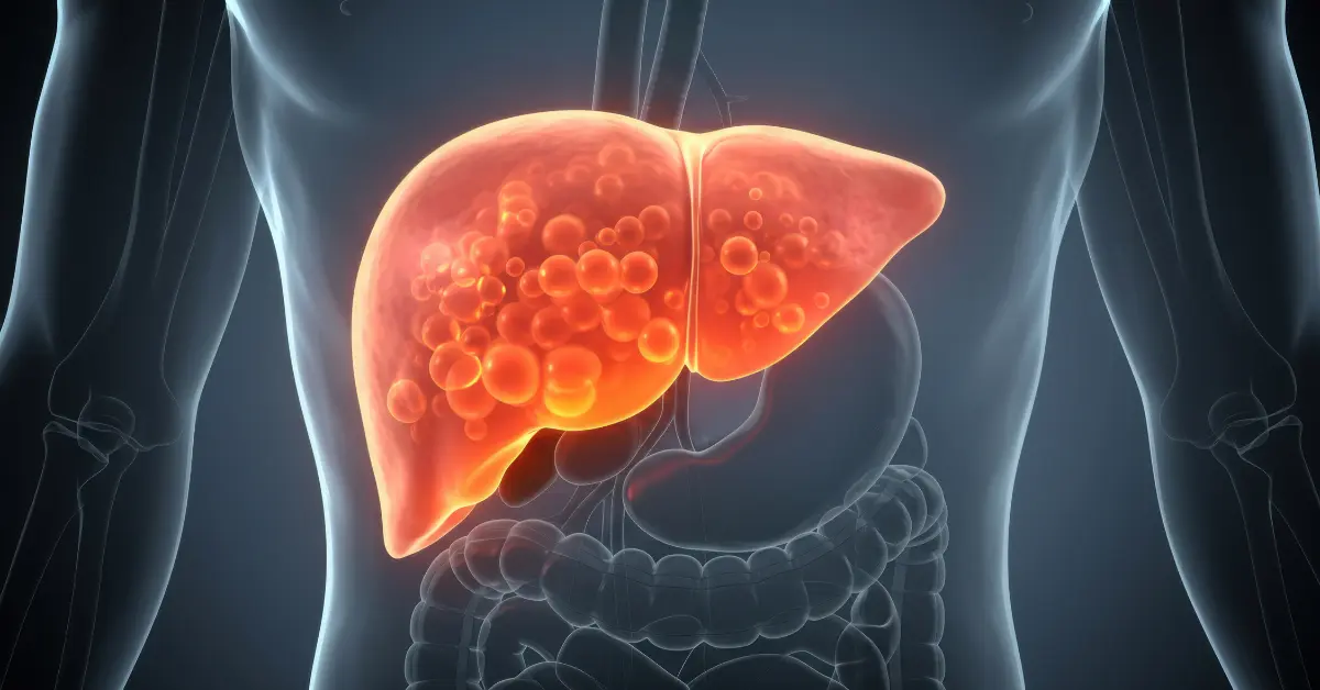 Fatty Liver Disease
