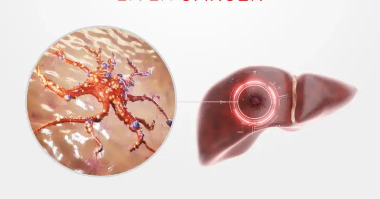 Liver Cancer