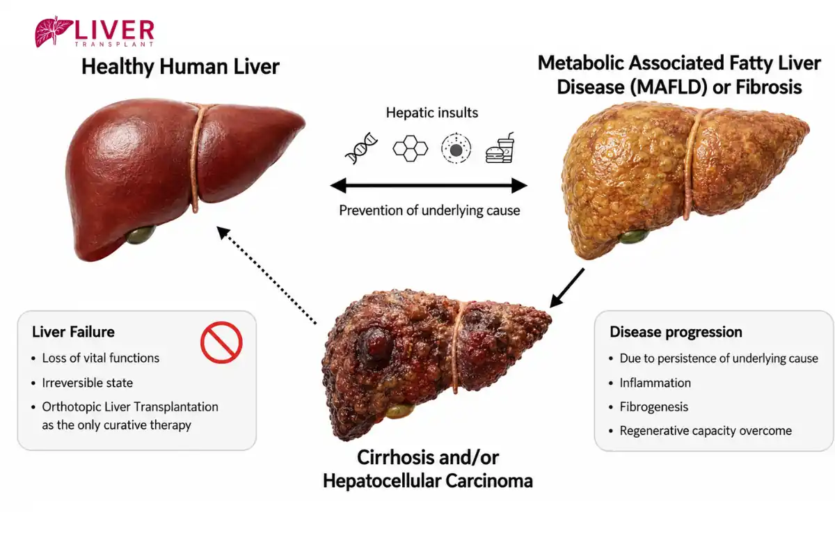 End-Stage Liver Disease