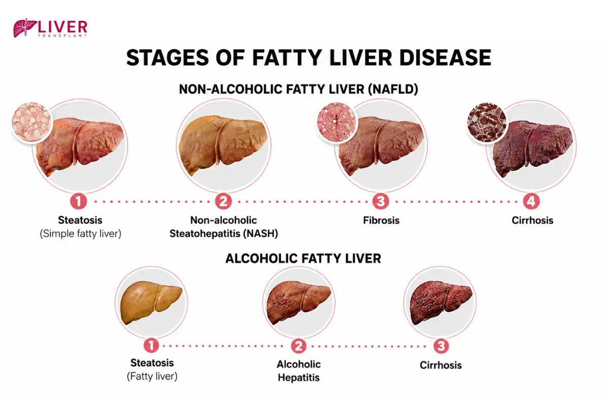 Fatty Liver Disease