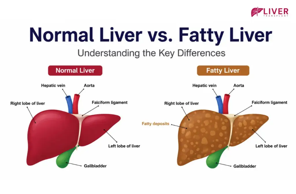 Fatty Liver Disease Treatment