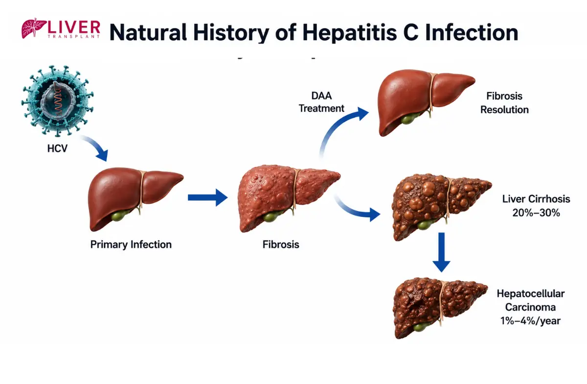 Hepatitis C