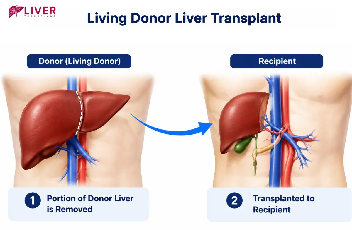 Living Donor Liver Transplant