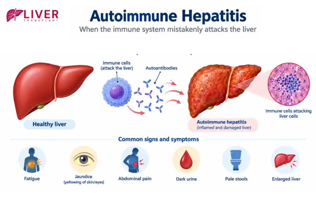 Autoimmune Hepatitis Symptoms