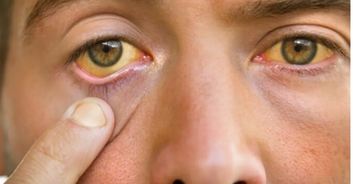 Jaundice in Adults