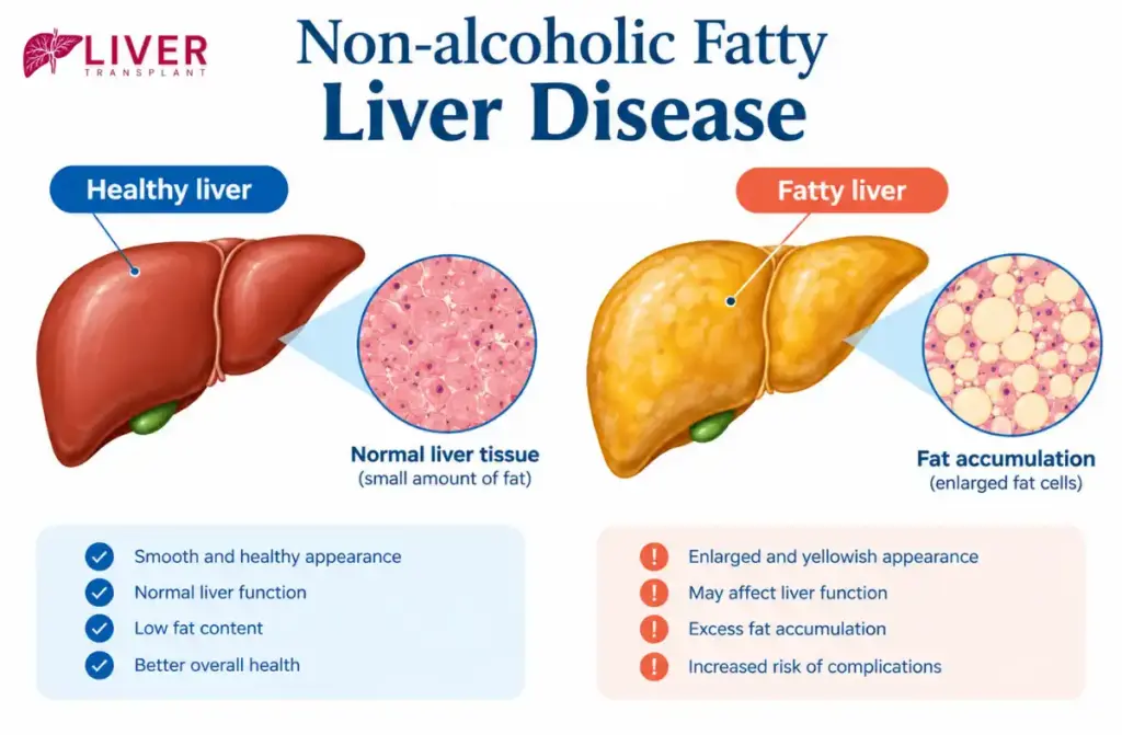 Non-Alcoholic Fatty Liver Disease